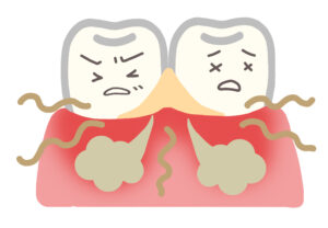 歯周病イラスト
